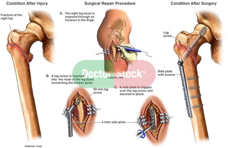 Right Hip Fracture and Emergency Surgical Repair